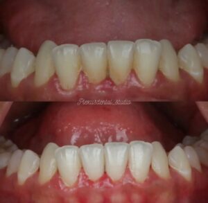 Bleeding gums treatment