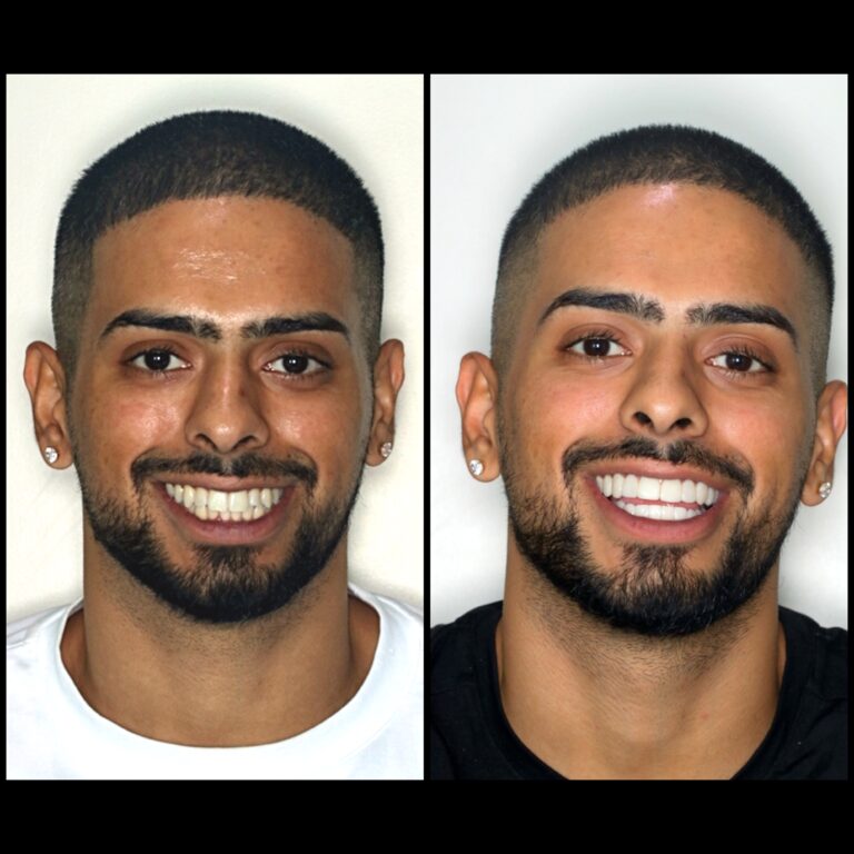 Smile Makeover Plexus Dental Clinic Andheri west