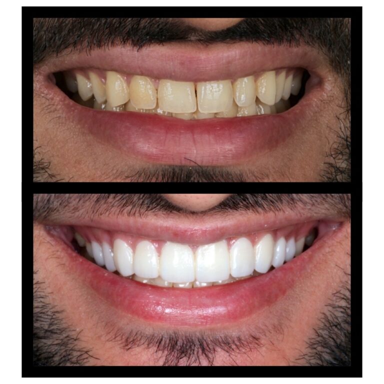 Smile Makeover Plexus dental studio andheri west