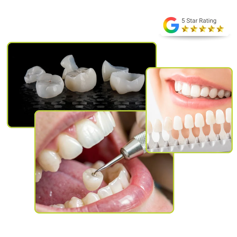 Dental Crowns Restoration in Andheri West - Plexus Dental Studio