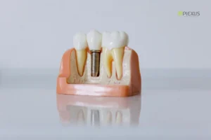 Dental Implants Plexus Dental Studio