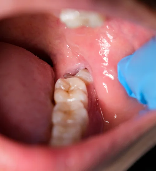 How To Extract Wisdom tooth? Plexus Dental Studio