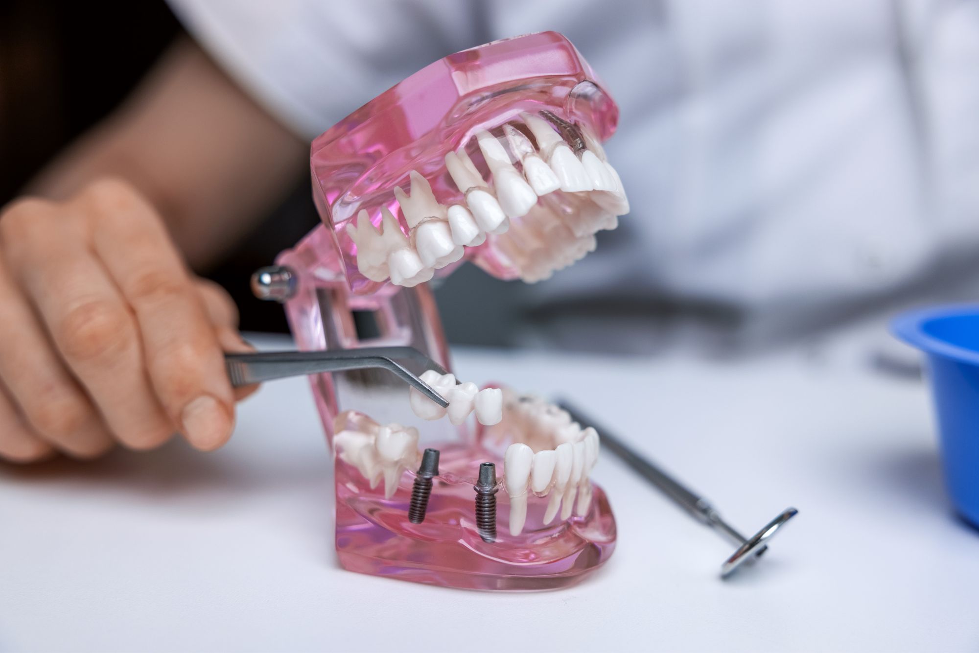 How Long Does Dental Crowns & Bridges Last