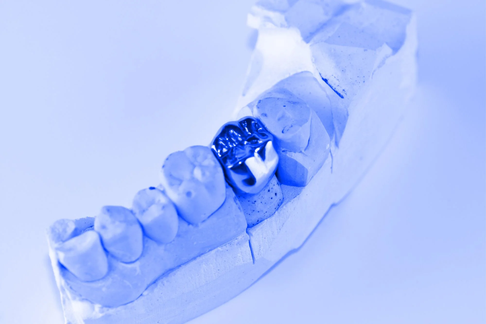 Most Durable & Advanced Dental Crowns Restoration
