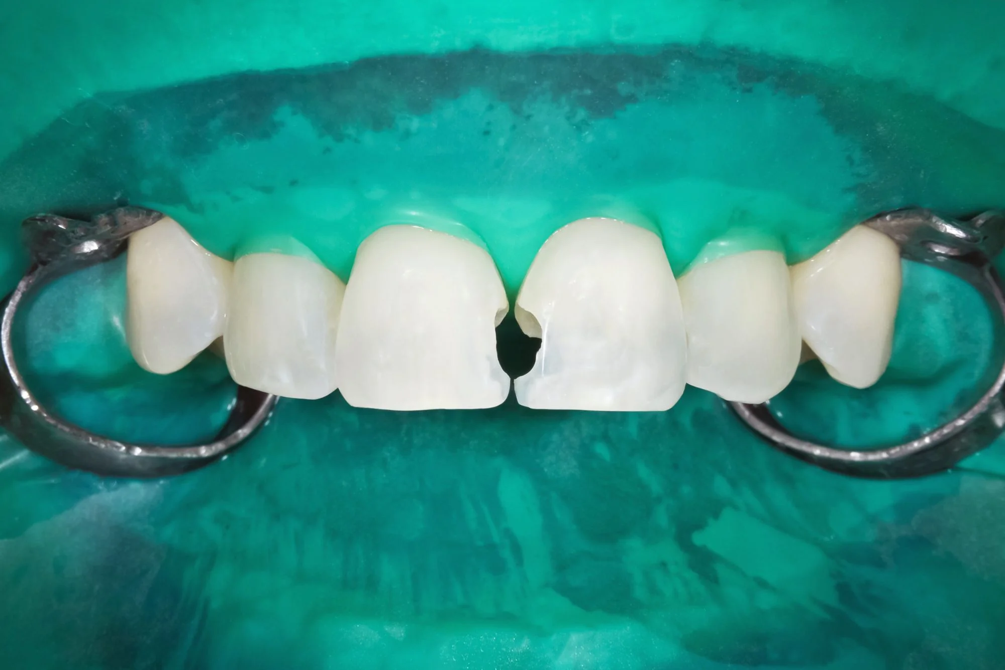 Mouth Rehabilitation : Plexus Dental Studio