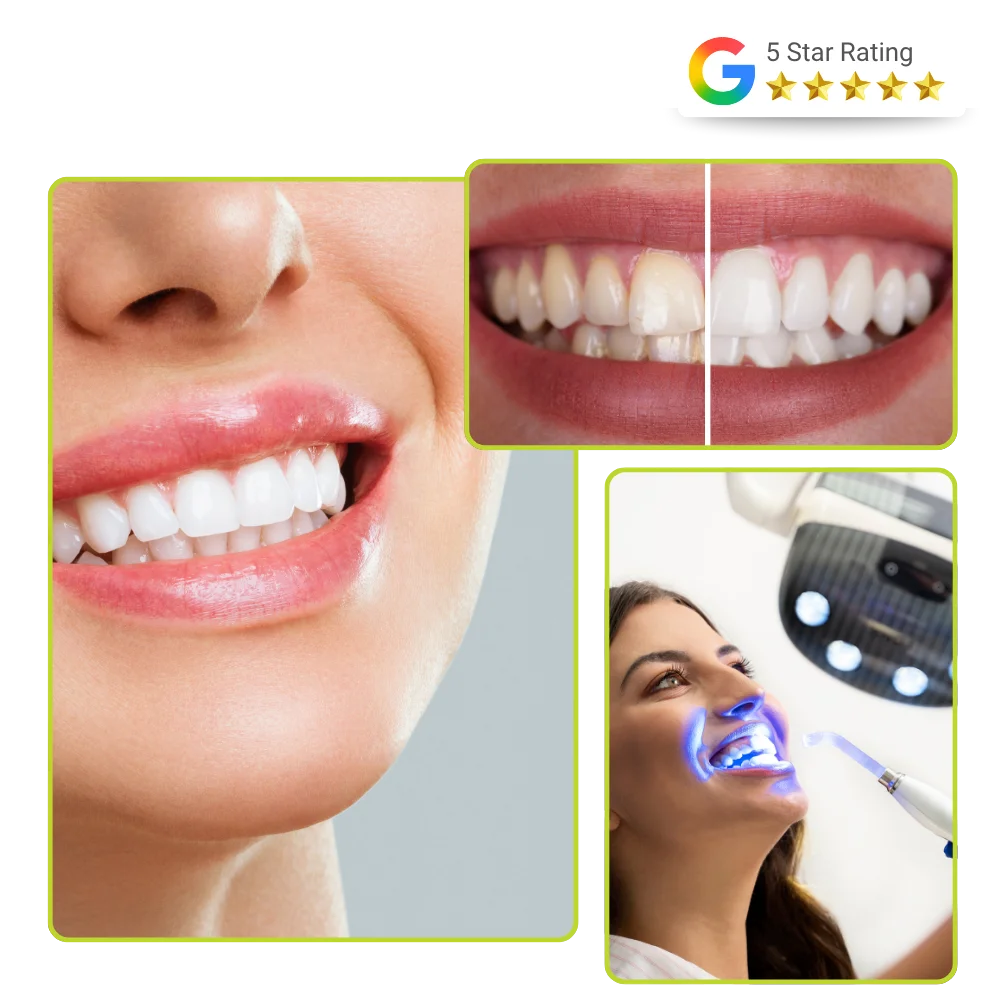 Teeth Whitening Services in Andheri West - Plexus Dental Studio