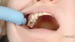 Root Canal Process | Plexus