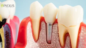 Root Canal Treatment | Plexus Dental 
