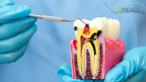 Root Canal Treatment_Plexus