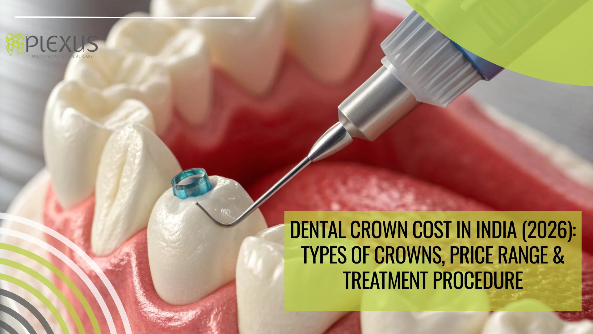 Dental Crown Cost in India (2026)