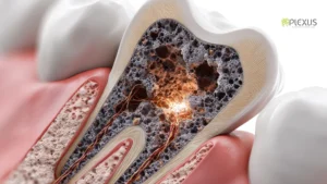 Tooth Cavity Filling Procedure
