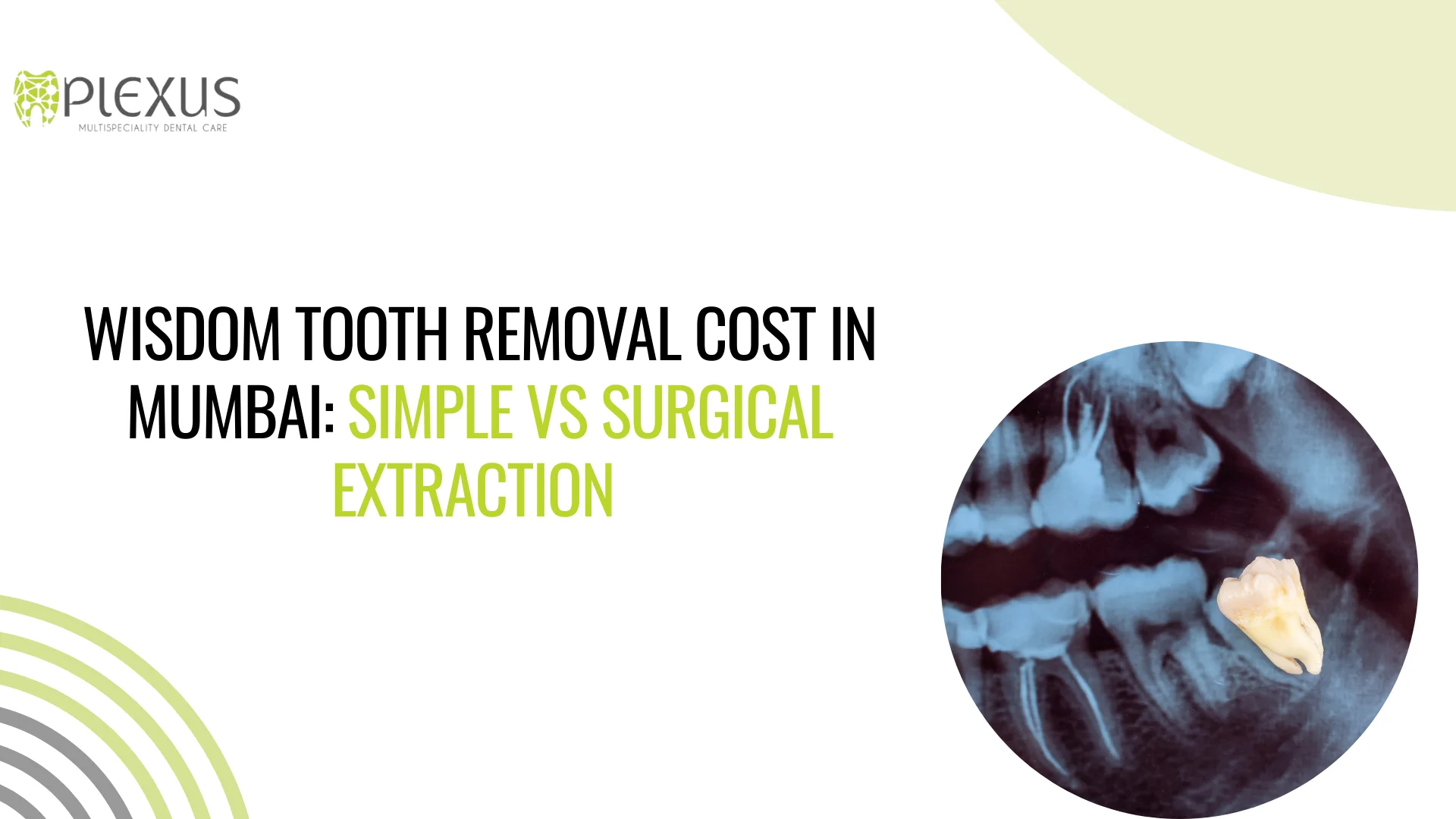 Wisdom tooth removal - Plexus