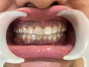 different types of braces