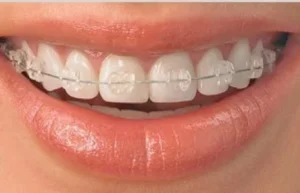 Ceramic Braces- different types of braces