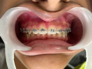 Metal Crowns - different types of braces