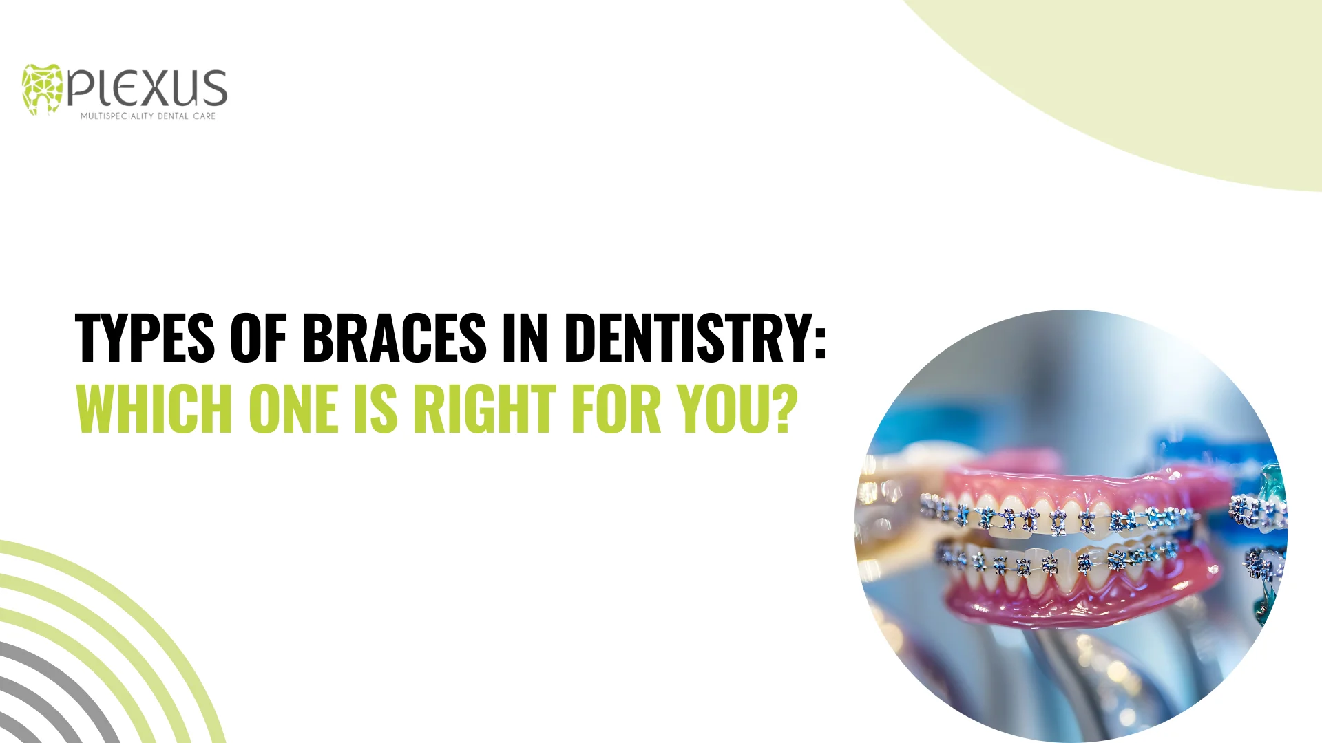Types of Braces in Dentistry Which One Is Right for You