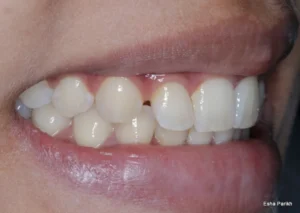 Bridal Smile Makeover