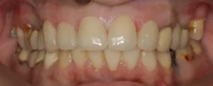 Dental veneers after
