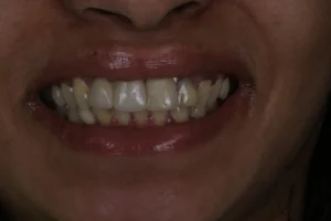 Smile makeover before