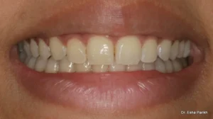 teeth whitening - Plexus