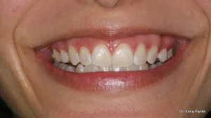 teeth whitening after