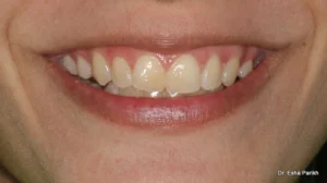 teeth whitening before