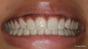 teeth whitening - bridal