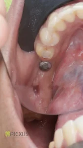 A well healing extraction socket after 10 days