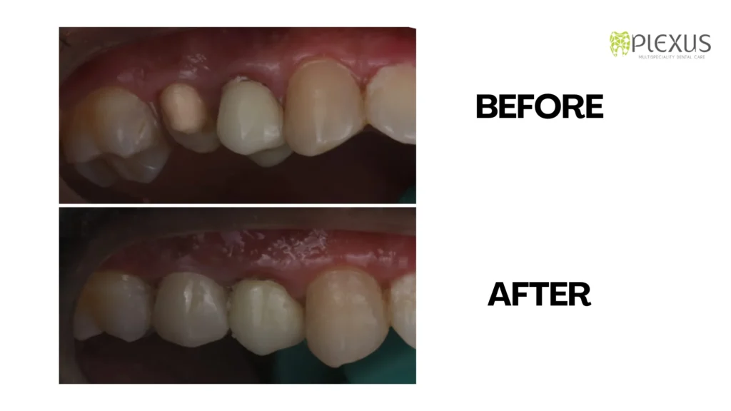 Before After - Dental Crowns | Renolet