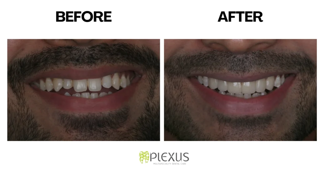 Before and After - Dental Veneers | Plexus Dental