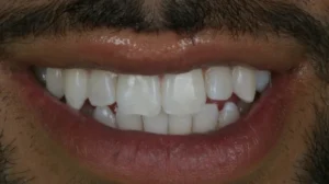 Chipped or crooked teeth