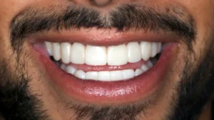 Composite Veneers - Plexus Dental
