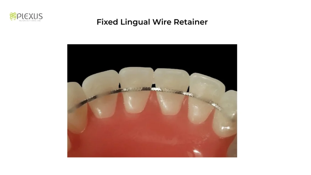 Fixed lingual wire retainer