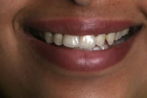 Rotated teeth