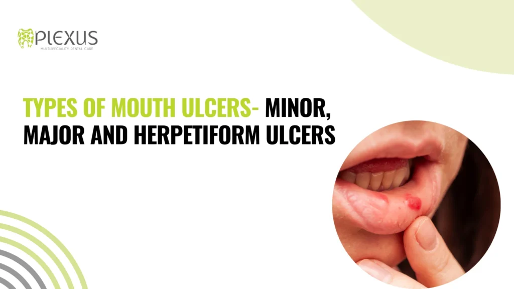 Types of mouth ulcers- Minor,major and herpetiform ulcers