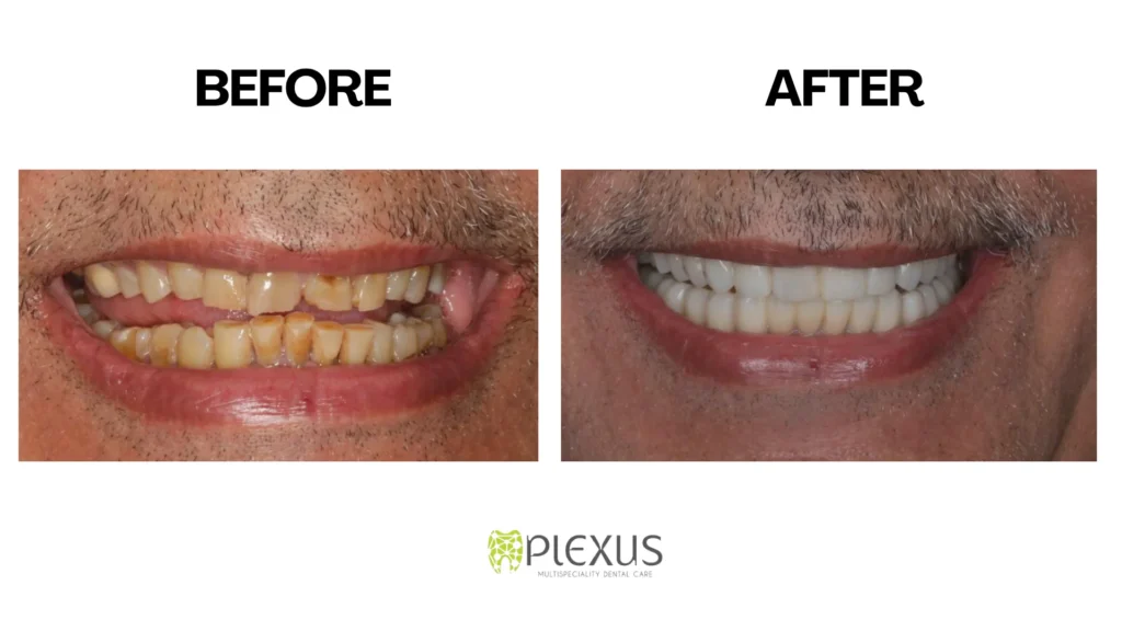 translucent teeth before and after
