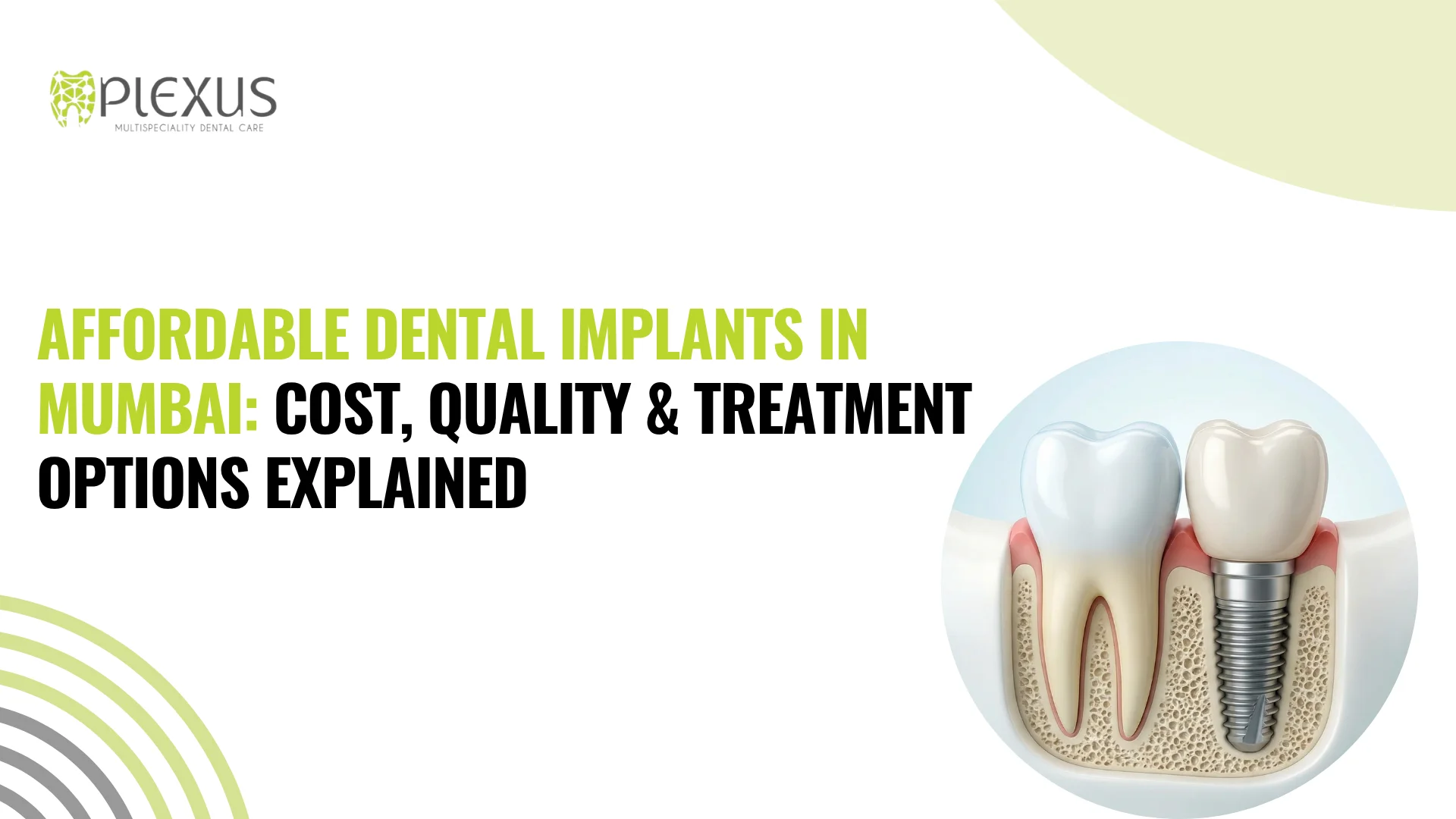 Affordable Dental Implants in Andheri West Cost, Quality & Treatment
