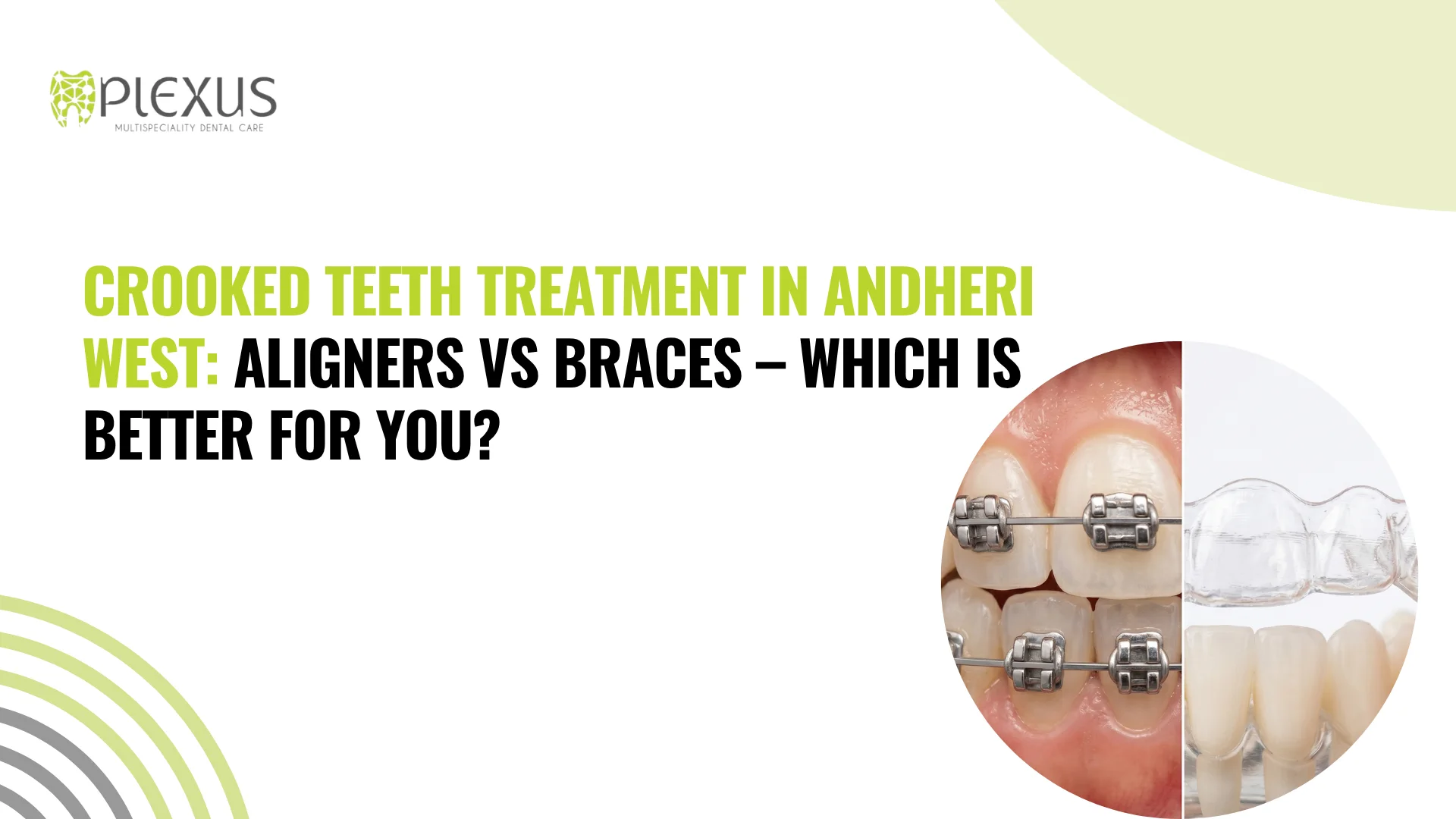 Crooked Teeth Treatment in Andheri West