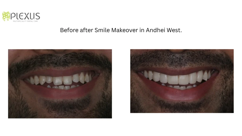 Before after smile makeover in Andhei West.