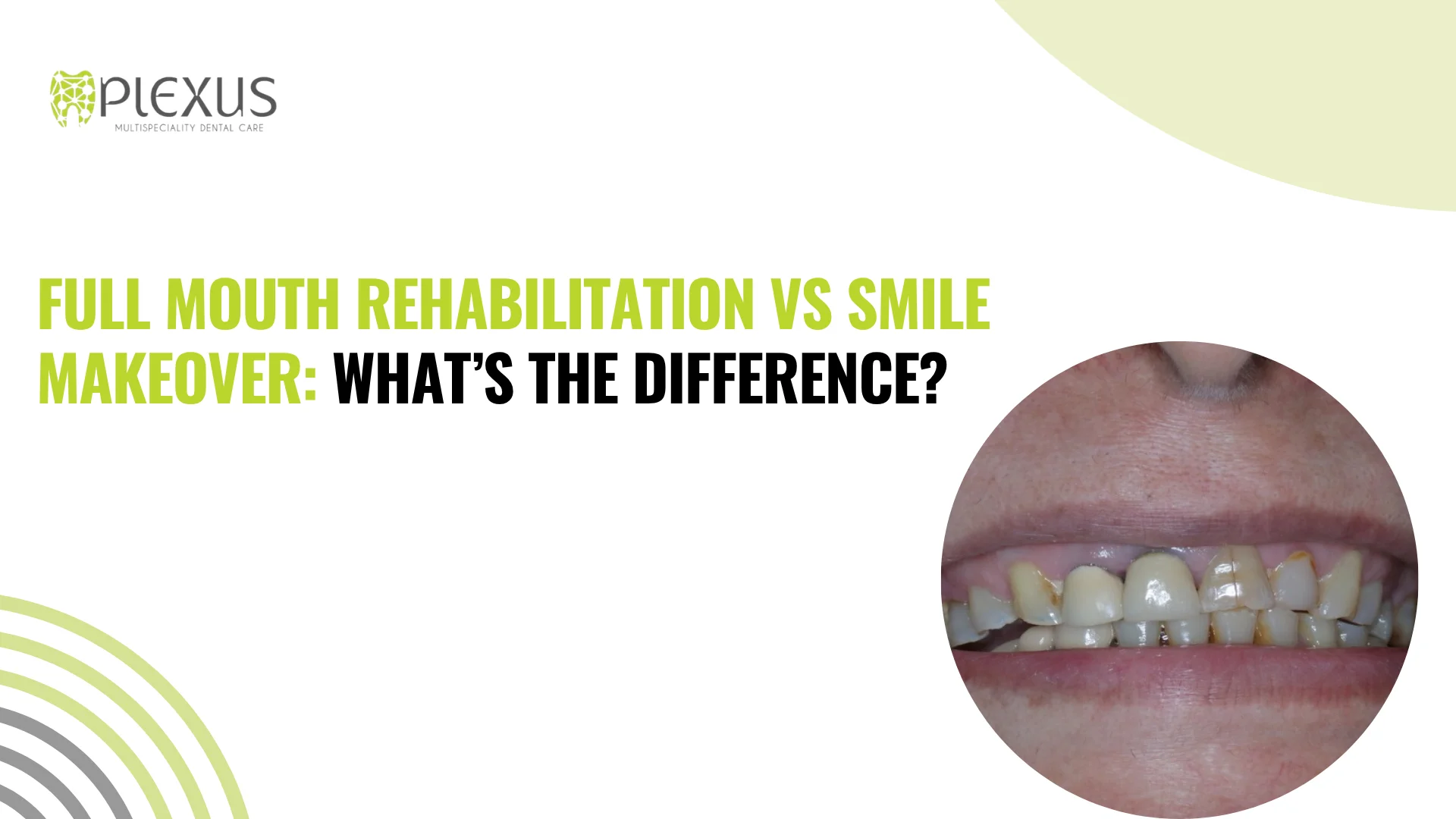 Smile makeover vs full moth rehabilitation