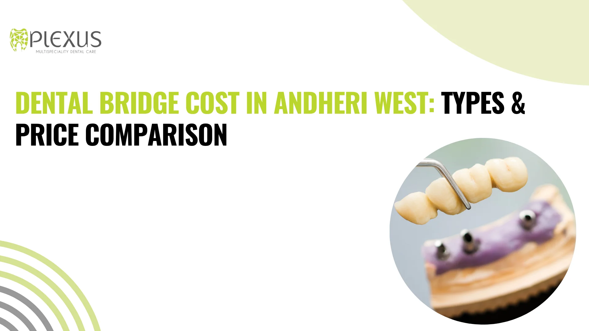 Dental Bridge Cost In Andheri West Types And Price Comparison