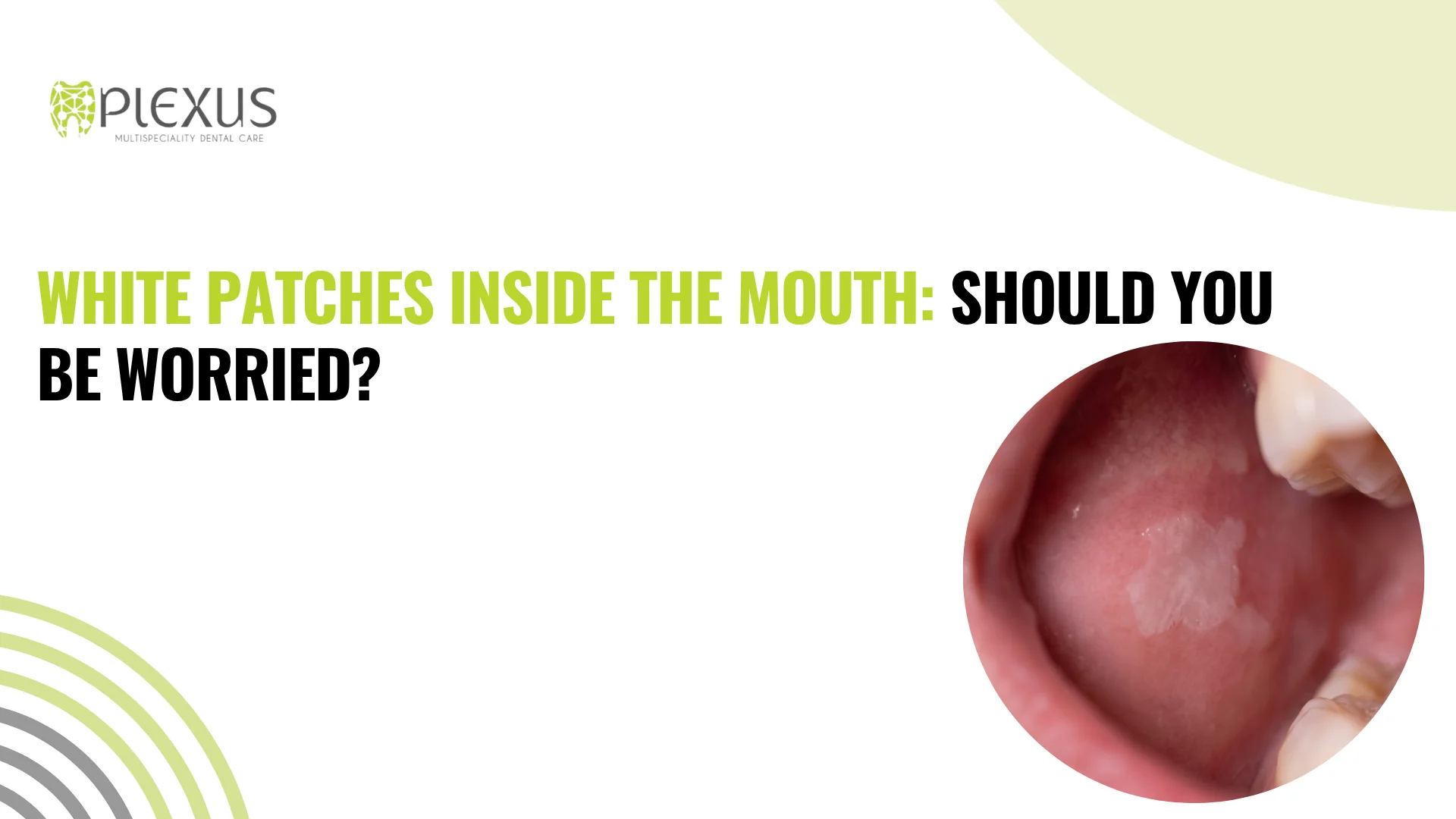 White Patches Inside the Mouth Should You Be Worried