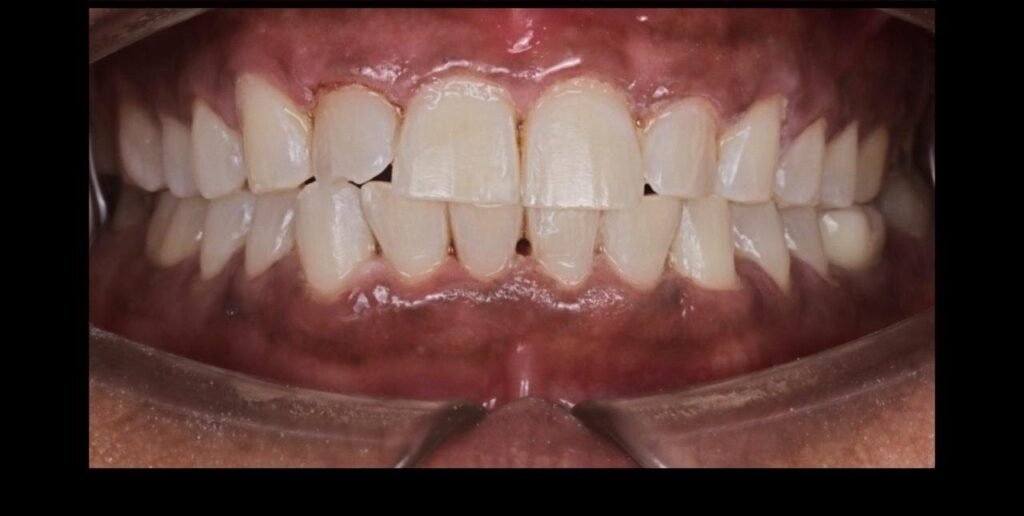 Case 2 smile transformation at Plexus Dental Studio