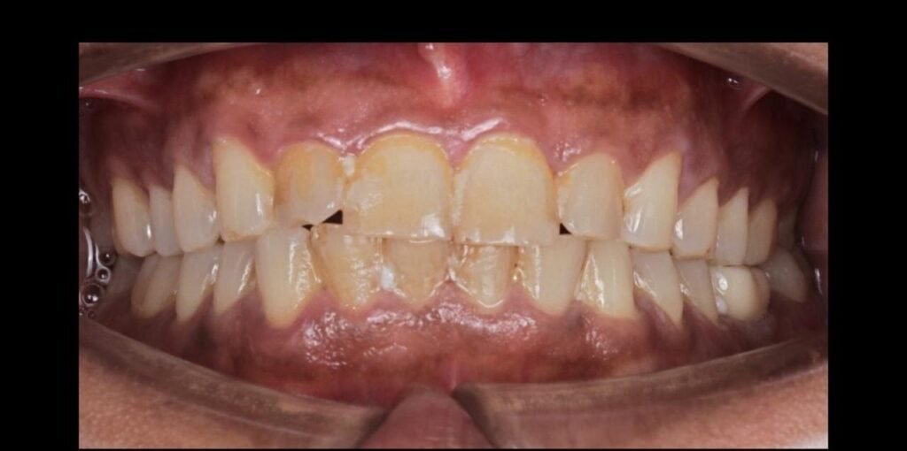 Case 2: Teeth Whitening at Plexus Dental Studio