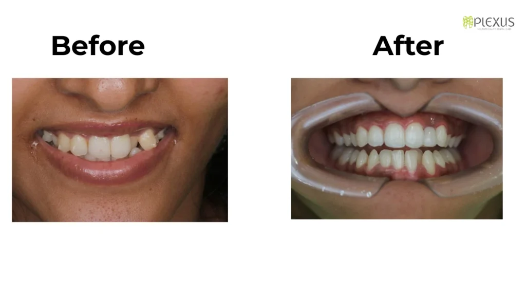 Case Study - wedding smile makeover
