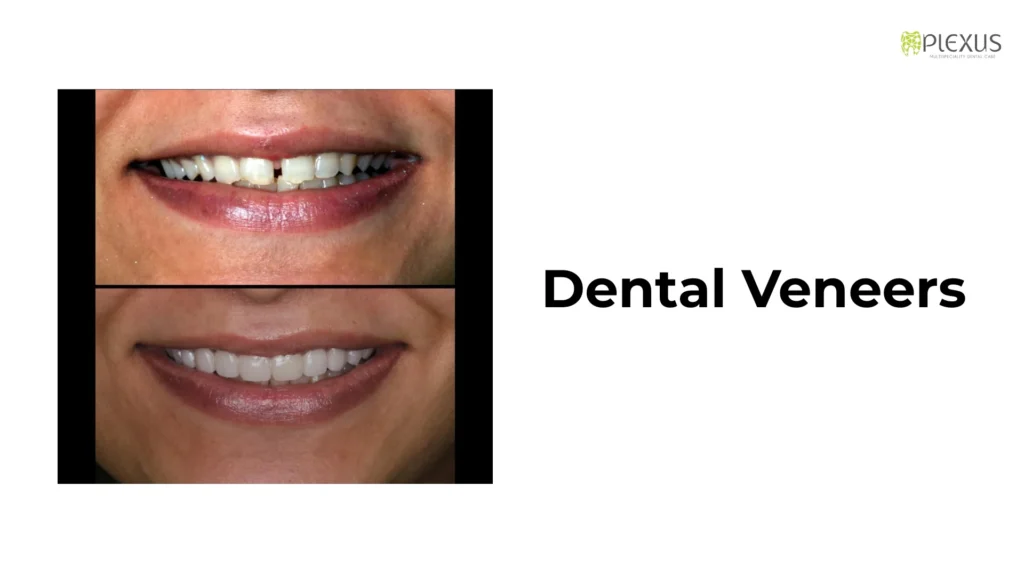 Dental veneers - wedding smile makeover