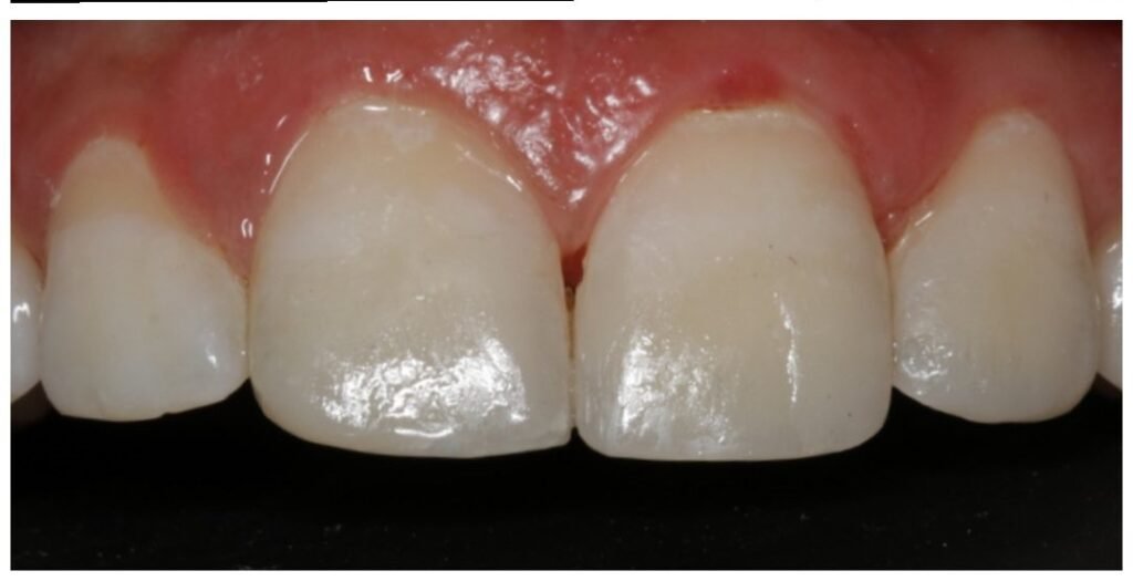 Case 6 smile transformation at Plexus Dental Studio