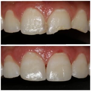 Smile Makeover