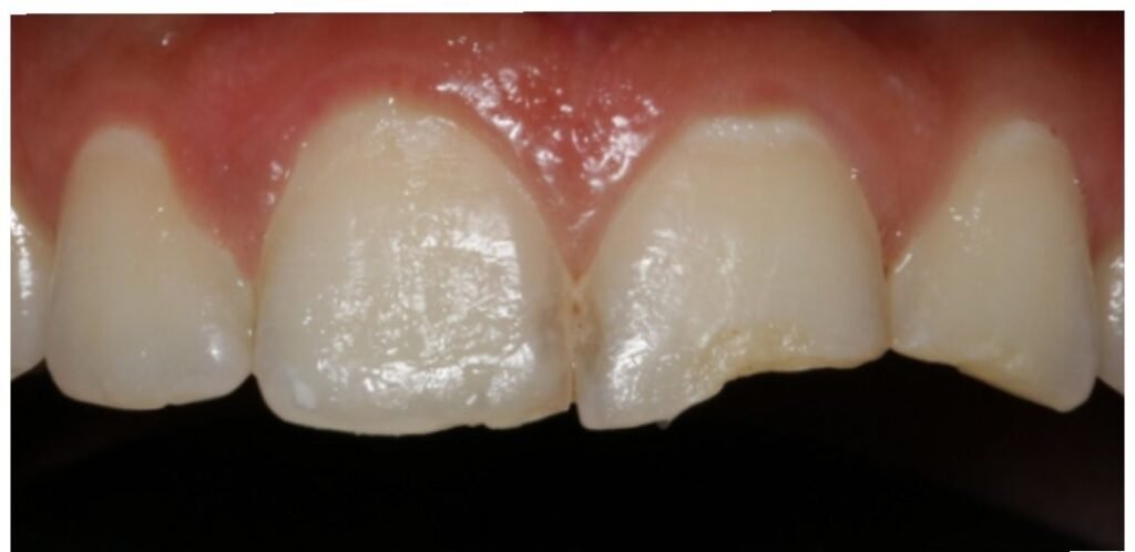 Case 6: Dental Bonding at Plexus Dental Studio