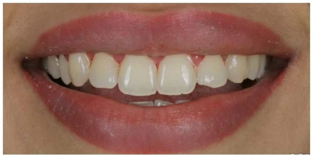 Case 7: Teeth Whitening at Plexus Dental Studio